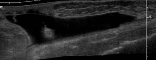 Proximal lateral