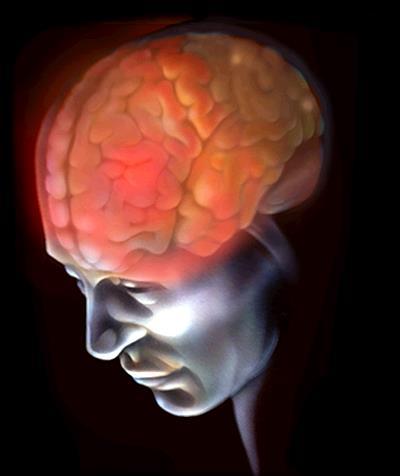 Mechanisms of Headache in Intracranial Hypotension Stephen D Silberstein, MD Jefferson Headache Center Thomas Jefferson University