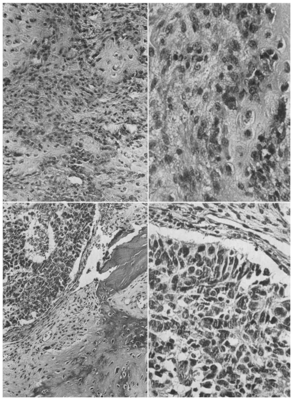 67-9900.) FIG. 21 (upper right). Case 4. The cellularity and pleomorphism of the cells in the fracture callus from Case 4 are shown at higher magnification. Hematoxylin and eosin. X 350. (W.U.