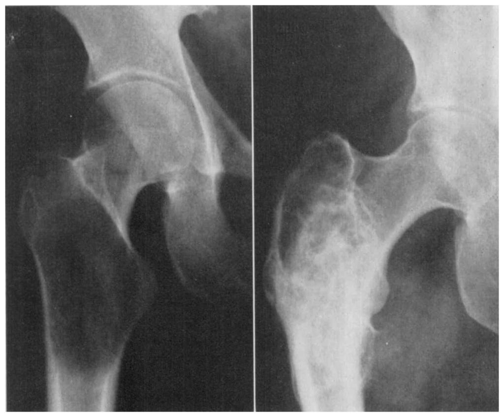 There is deformity of the femur indicating healing of a previous fracture. (W. TJ. 62-8760.