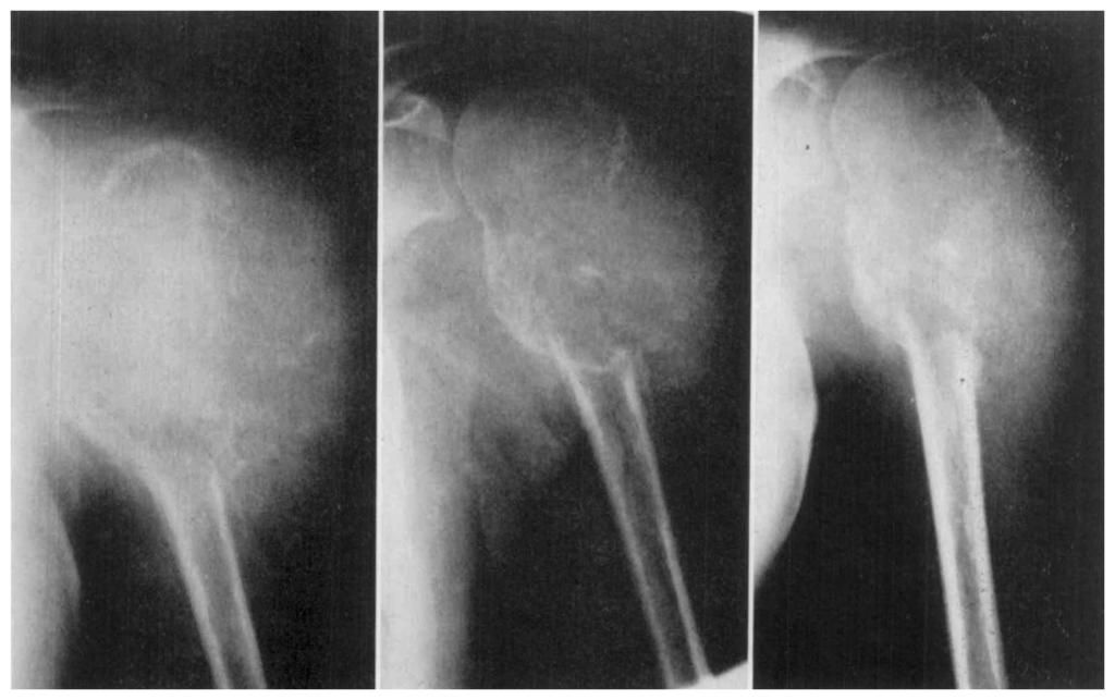 B (middle), J a n u a r y 2, I960. C (right), February 22, 19(30: the configuration of calcification within the lesion suggests loculation.