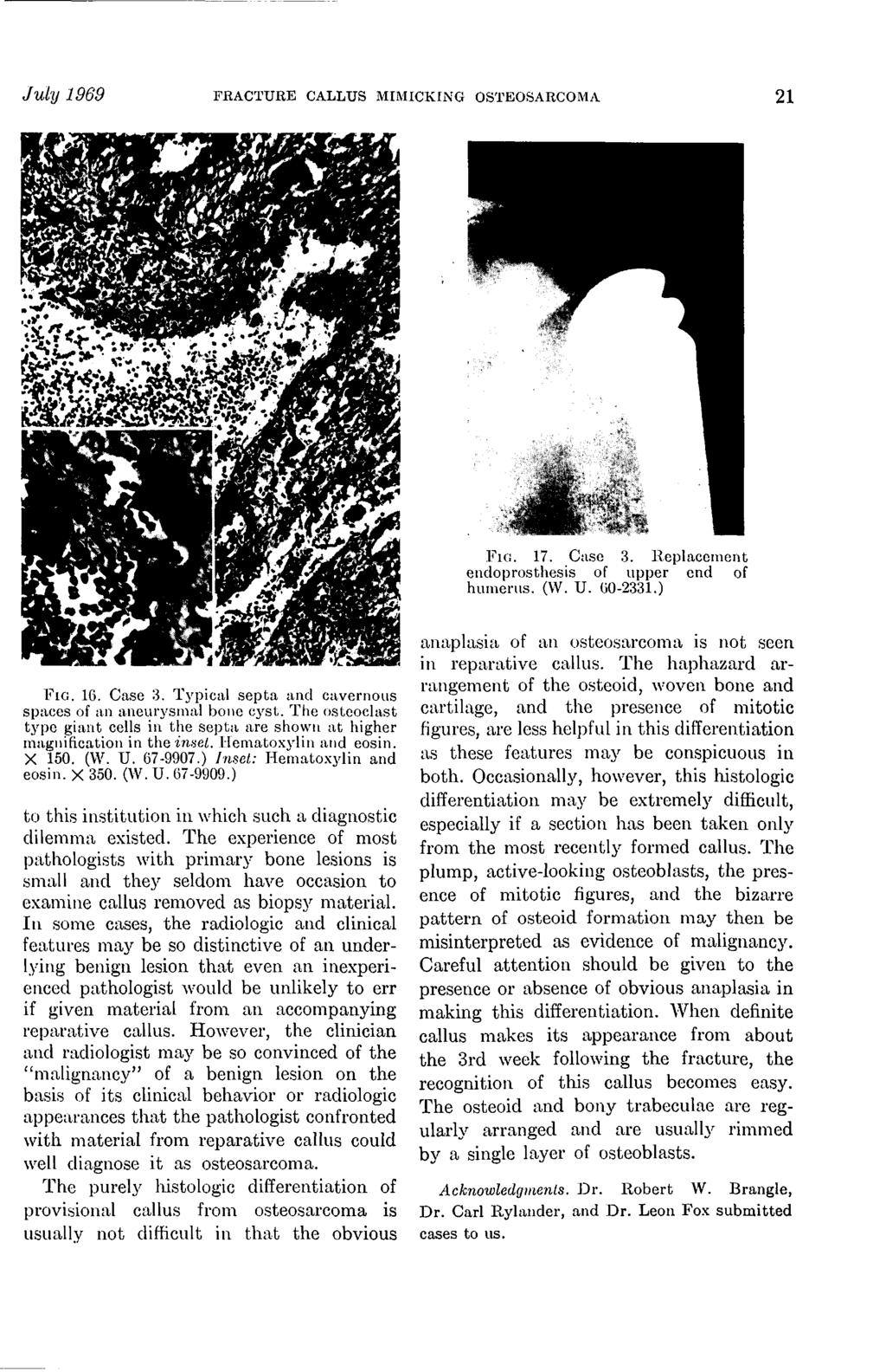 July 1969 FRACTURE CALLUS MIMICKING OSTEOSARCOMA 21 J&-, FIG. 17. Case 3. Replacement endoprosthesis of upper end of humerus. (W. U. 60-2331.) FIG. 16. Case 3. Typical septa and cavernous spaces of an aneurysmal bone cyst.