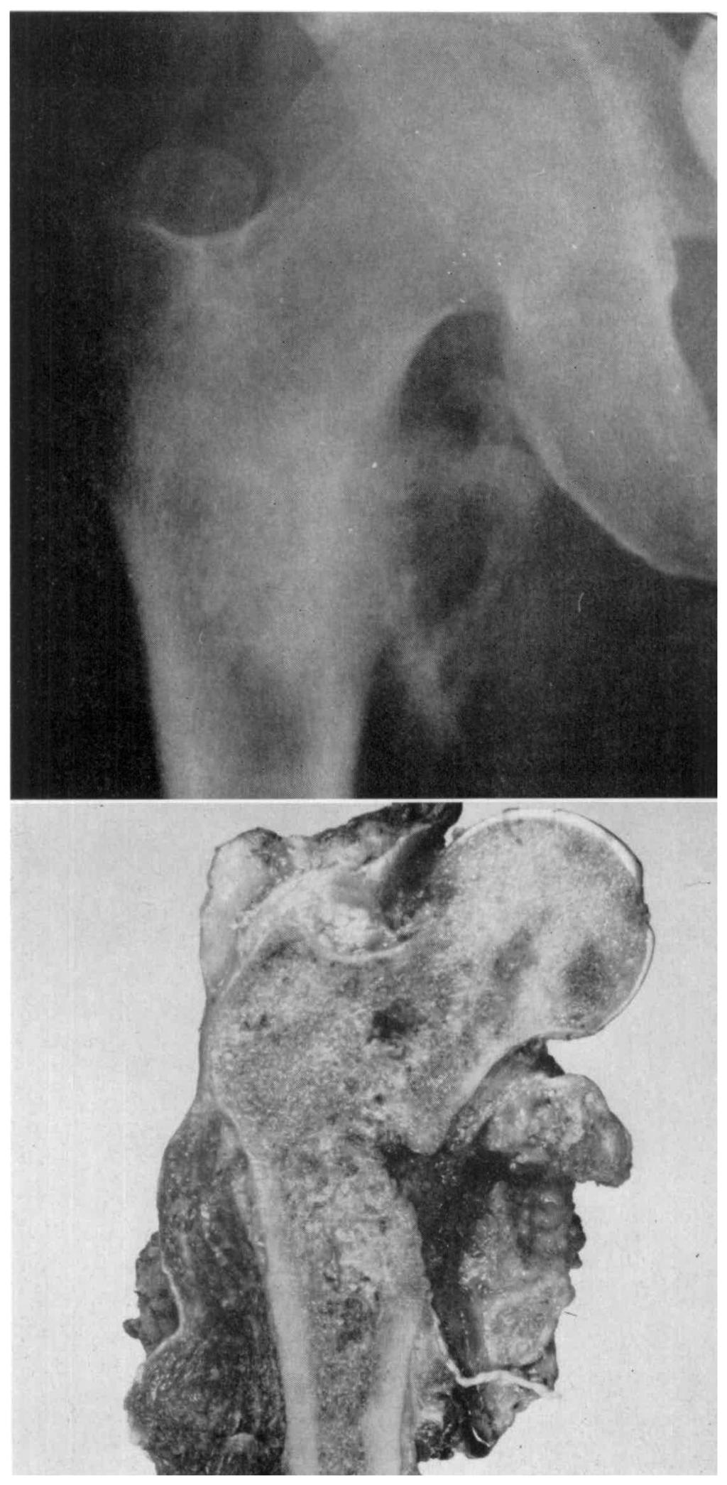 The lesser trochanter is destroyed, and extensive soft tissue calcification is present.