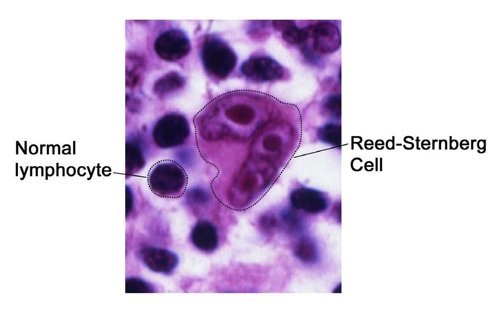 In classical Hodgkin lymphoma, the abnormal cell is called a Reed-Sternberg cell. See photo of the large cell below. Reed-Sternberg cells are much larger than normal lymphocytes.