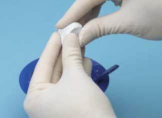 3 Implant and contour material (within 2 minutes) Immediately apply the Norian SRS Fast Set Putty to the stabilized defect site with the spatula or by hand.