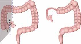 Common types of Colon Resection Surgery Right Hemicolectomy Part or