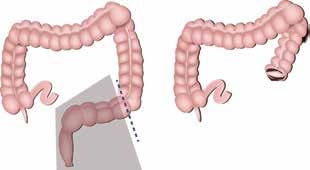 The transverse colon is then reconnected to the rectum.
