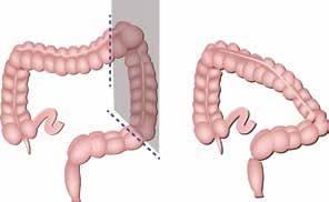 The descending colon is then reconnected to the rectum.