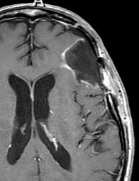 esophageal 1, HA, expr aphasia; confusion; no systemic disease Pre-op 1 mo post-op 30 15 9 4 CK plan: 30 Gy/5 fxs to cavity + 2 mm margin Chemotherapy Blood brain barrier: fact or fiction?