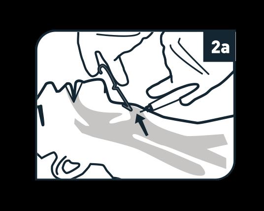 Control-Cric Instructions for Use While maintaining downward force, slide the tracheal hook down the handle with your thumb