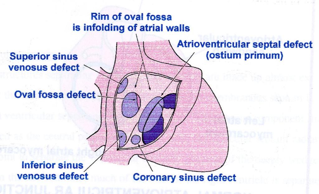 Shunts at Atrial Level 1. PFO 2. Secundum Atrial Septal Defect (Fossa Ovalis Defect) 3.