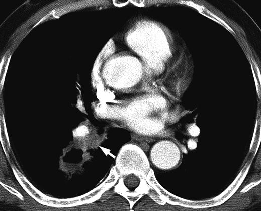 CT of Pleomorphic Carcinoma of the Lung tumor necrosis on contrast-enhanced CT scans (Fig. 3).