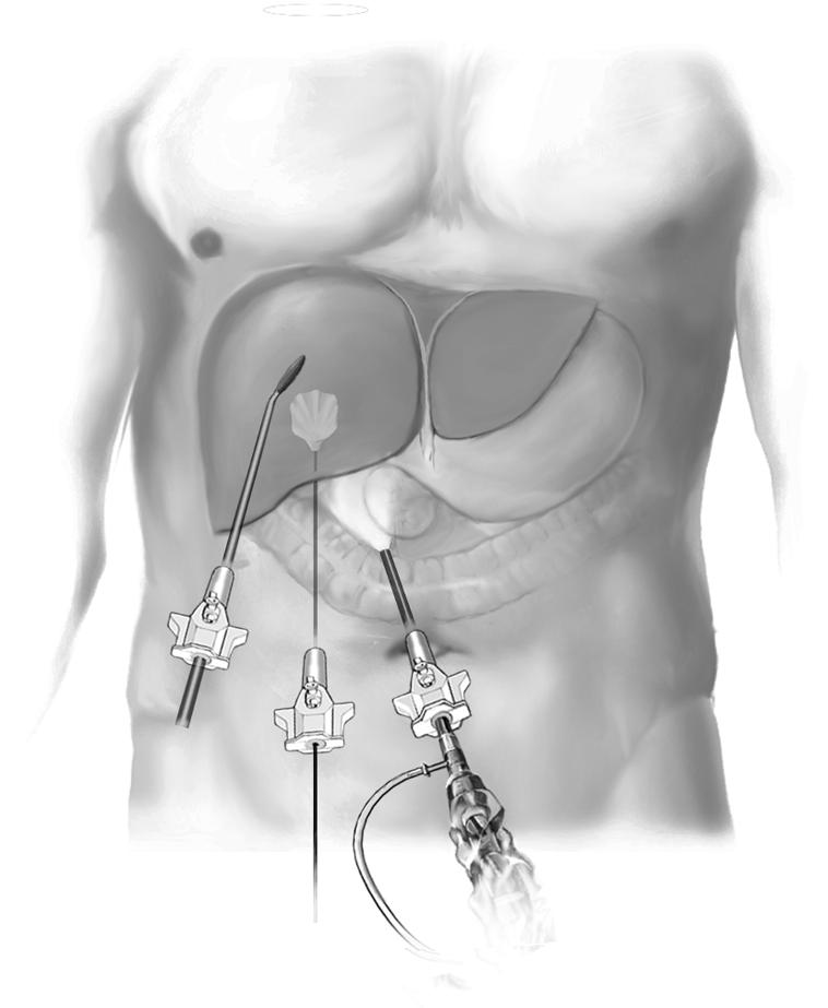 Radiofrequency Ablation of Liver Tumors 413 Laparoscopic Approach STEP 1 Positioning of the patient and access Depending on the location of the tumor(s), the patient is placed in the supine or left