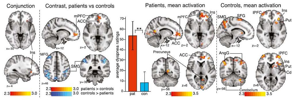 Brain Processes Associated with Responses to Dyspnearelated Cues in COPD Patients Investigators studied fmri imaging to identify brain activity in 41 patients with COPD vs 40 control subjects after