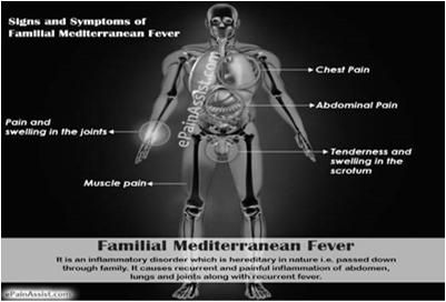 Attacks of FMF begin before the age of 20 in 90% of patients. In 75% of patients, fever appears before the age of 10 years. It is a chronic life long disease and there is no known cure.