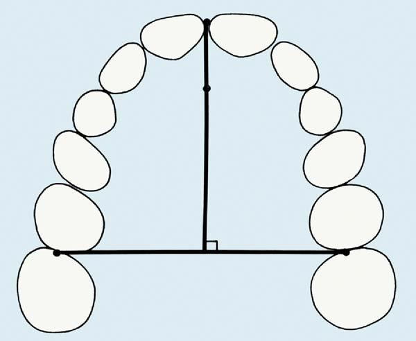 Similar midpoint (B) was constructed midway between buccal and lingual landmarks of tooth. Centroid (C) was located midway between points A and B. Fig 5.
