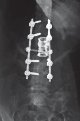 Spinal Oncologic Reconstruction either vertebrectomy (partial or total) or palliative surgery because of extensive involvement and spread (Figure 2) (15).