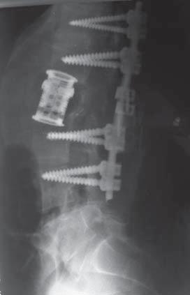the spine.