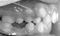 Bands on upper 6 s (with occlusal headgear tubes) and upper 4 s (If serial extraction of all first bicuspids, band the upper e s or 5 s and 6 s.) 3.