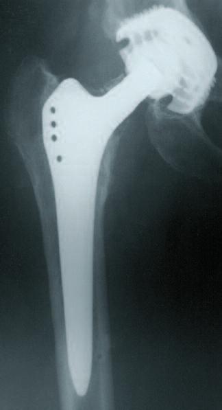 Postoperative, 10 Years Anterior-posterior X ray at 10 years, with signs of stable osseointegration of both components and positive bone remodeling