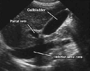 Find that CBD Follow the gallbladder neck to the portal triad.