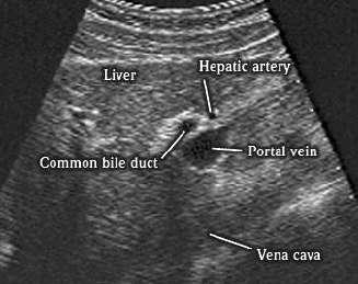 Porta Hepatis=Portal Triad Rotating the probe on the portal vein should bring the common bile duct,