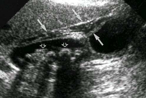 Acute Cholecystitis The solid arrows are pointing to the