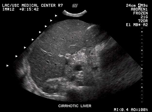 Cirrhosis-Early Stage Loss of peripheral hepatic vessels