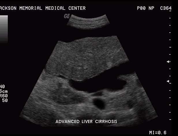 Cirrhosis Advanced Stage Nodular liver