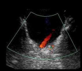 Ureteral Jets Color Doppler probe is used to find urine squirting from the ureter