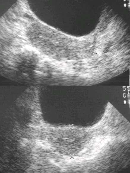 Urinary Bladder Female patient (note the uterus).