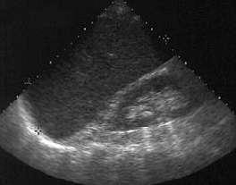 Splenomegaly The normal spleen measures less than 12 cm long, 5 cm thick and 7 cm in breadth.