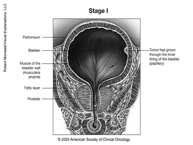 CS Extension: Bladder Code 155: Subepithelial connective tissue (tunica propria, lamina propria, submucosa, stroma) of bladder only Includes confined to mucosa if tumor penetrates basement membrane