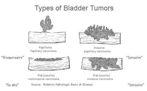 Bladder Subsites Priority order for coding bladder subsite Op report Path report Assign C67.