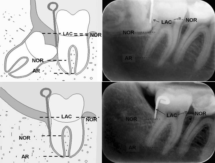 modified device for intraoral radiography to assess the distal osseous defects of mandibular second molar after impacted third molar surgery used to measure the linear radiographic distances.