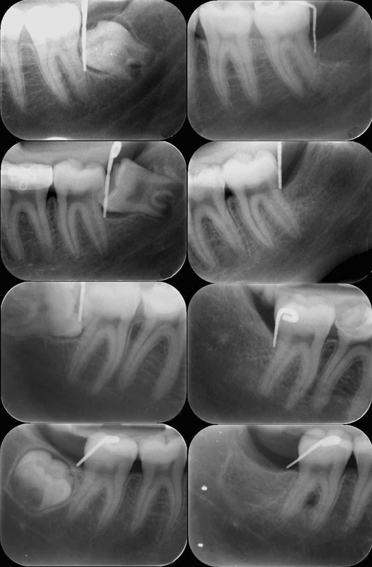 Faria-Inocencio na et al Fig. 6. Four examples of periapical radiographic images.. Initial radiographic image before extraction of the mandibular third molar.
