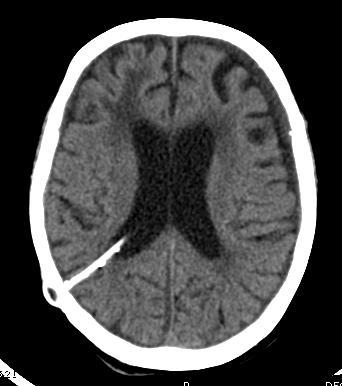 CT brain