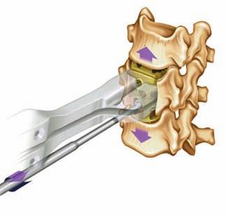 The titanium TeCorp VBR system implanted via the anterior or anterolateral approach is