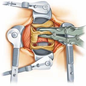 2 Discectomy and corpectomy First, a discectomy above and below the affected area is performed, followed by a corpectomy using the usual instruments.