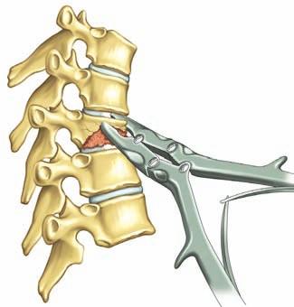 The lumbar vertebral reconstruction is technically similar except for the approach which consists in a median or