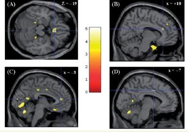 Do CU traits and CP have distinct contributions to neural activity in affect/empathy processing