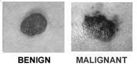 Risk Factors for Melanoma Sun exposure Moles Skin type Personal history Family history Weakened immunity Genetics Melanoma Originate in melanocytes in basal layer of epidermis Can originate in a mole