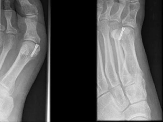 Osteoarthritis This may be associated with Hallux rigidus or localized to the sesamoid metatarsal articulation. This can develop secondary to trauma, chondromalacia or sesamoiditis.