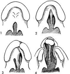 I. Veau classification: a. Group 1: soft palate only b. Group 2: clefts of the soft & hard palate reaching anteriorly as far as the incisive foramen. c. Group 3: includes complete unilateral alveolar clefts that generally involve the lip as well.