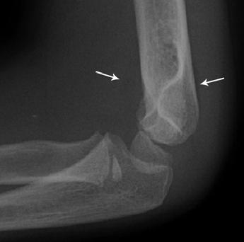 MDCT of the Pediatric Elbow spectively determine the performance characteristics of MDCT in the detection of radiographically occult fractures in pediatric patients with posttraumatic elbow effusions