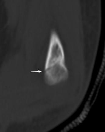 lateral radiographs obtained immediately after the trauma did not show a fracture. ll patients C were examined and underwent scanning within 48 hours of injury.