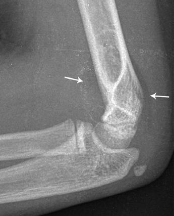 MDCT of the Pediatric Elbow orthopedist at the time of initial evaluation.