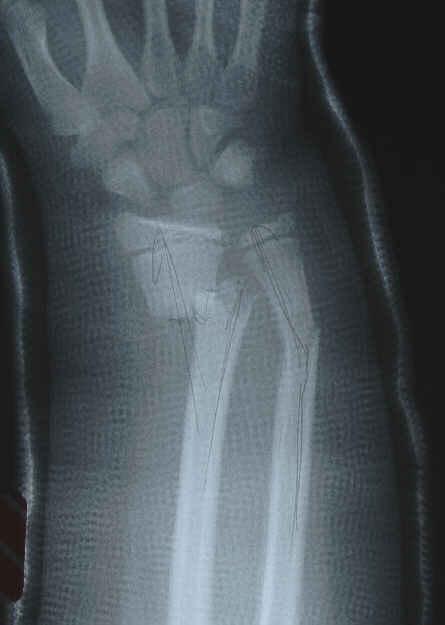 Complete Fractures Distal Radius and Ulna Fractures 9y/o girl