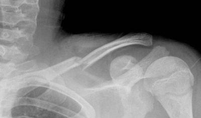 Clavicle Fractures S shaped bone. Middle 1/3 is most common site of fracture.