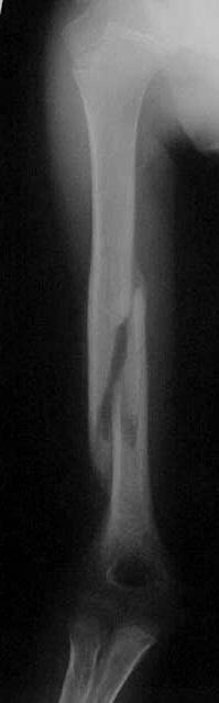 Diaphyseal Humerus Fracture Best Managed By Orthopaedist Coapt Splint Acutely may